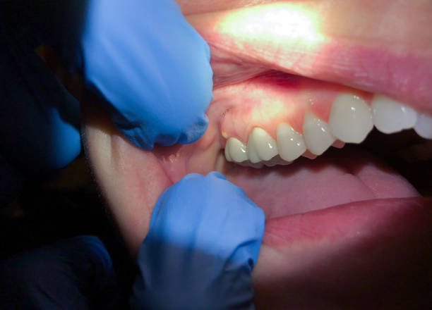 Best Emergency Tooth Extraction in Heavener, OK